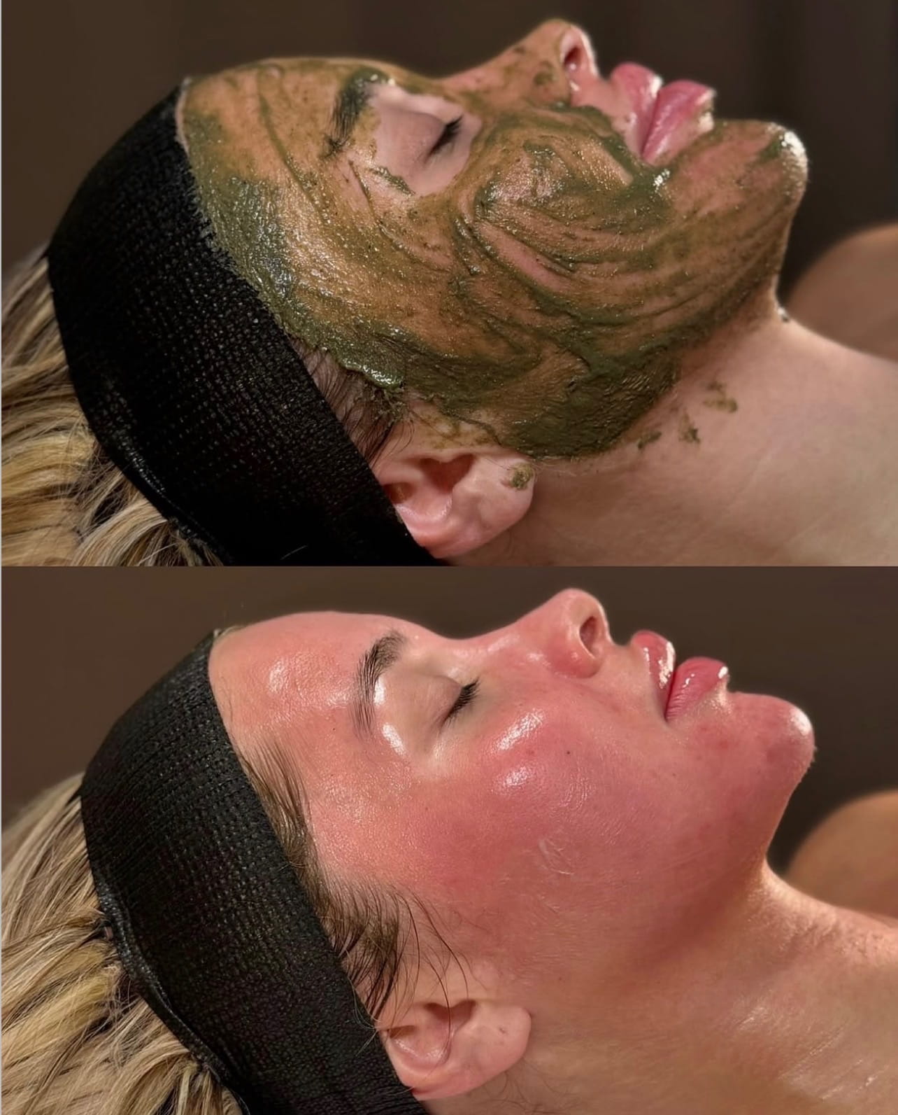 Algae Peel client result shared by Angela Aesthetics