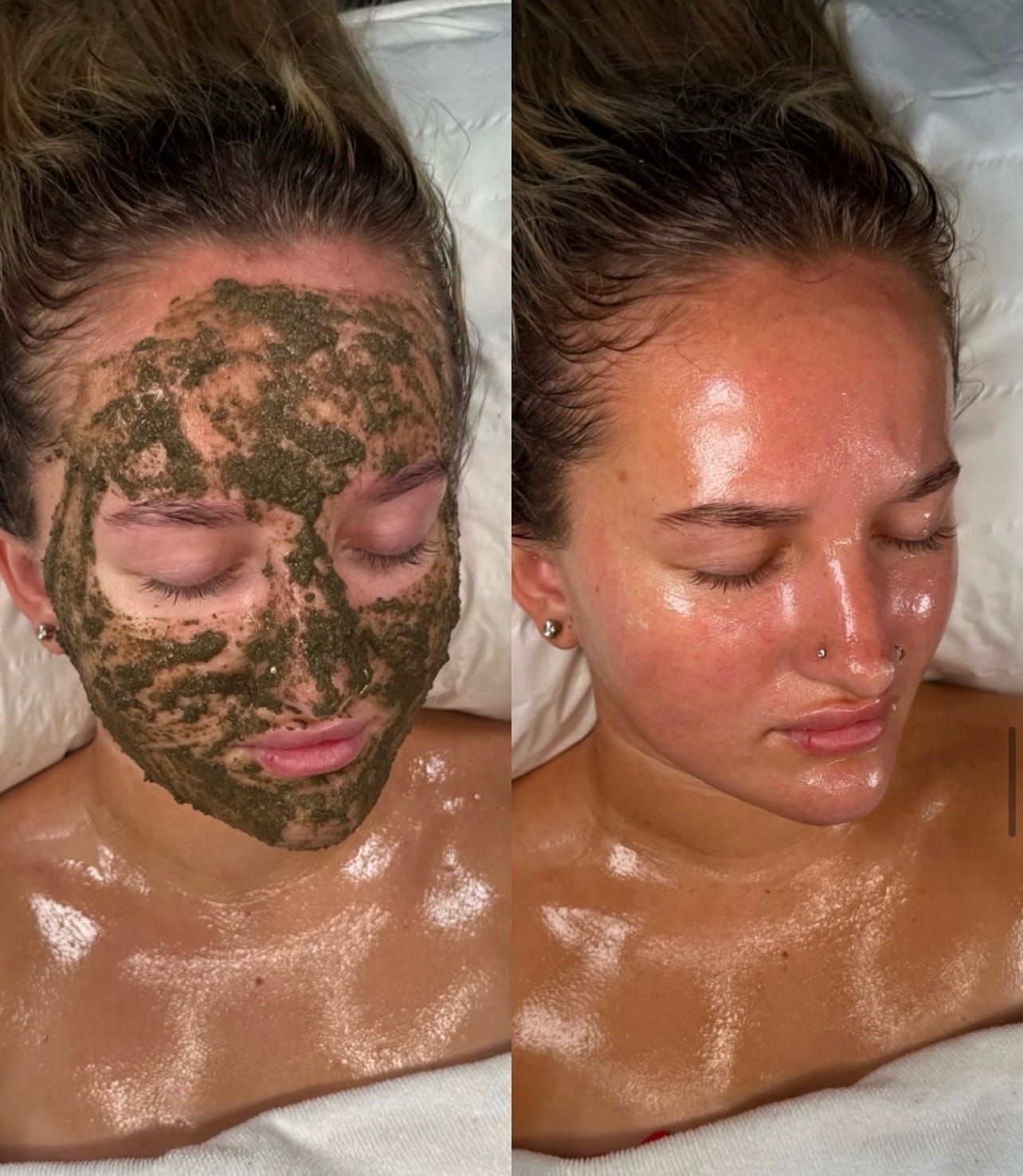 Glowing skin result after an Angela Aesthetics treatment