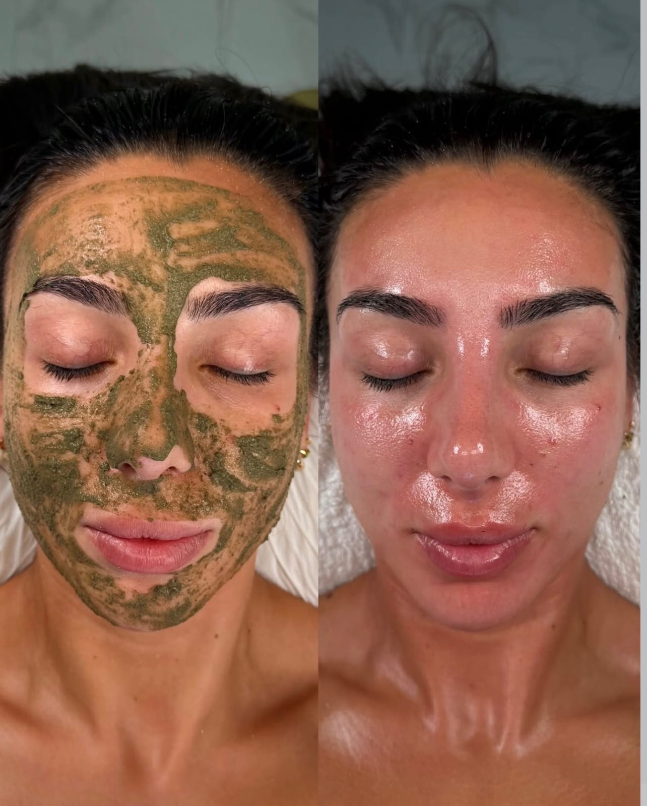 Loved by locals Algae Peel result